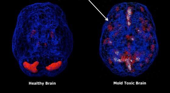Results of single-photon emission computed tomography